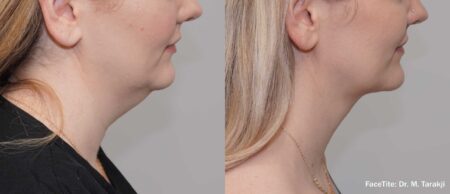 Mt Facetite Before After 6months Neck Tm Mt Facetite Before After 6months Neck Tm