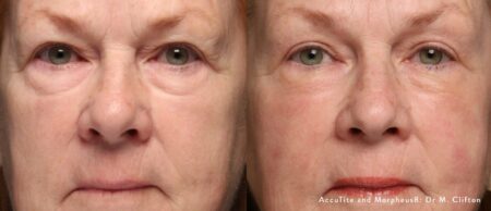 Accutite Morpheus8 Before After Dr M Clifton Preview 1 Accutite Morpheus8 Before After Dr M Clifton Preview 1